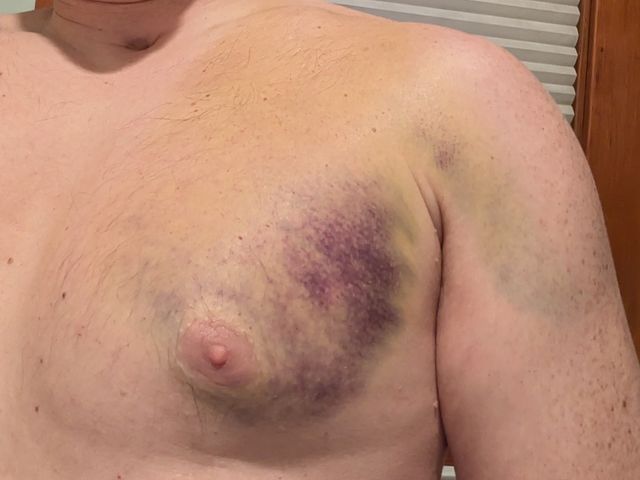 a dark purple comma-shaped bruise on my left pectoral, plus yellow-green bruising above it, as well as on the upper part of my arm